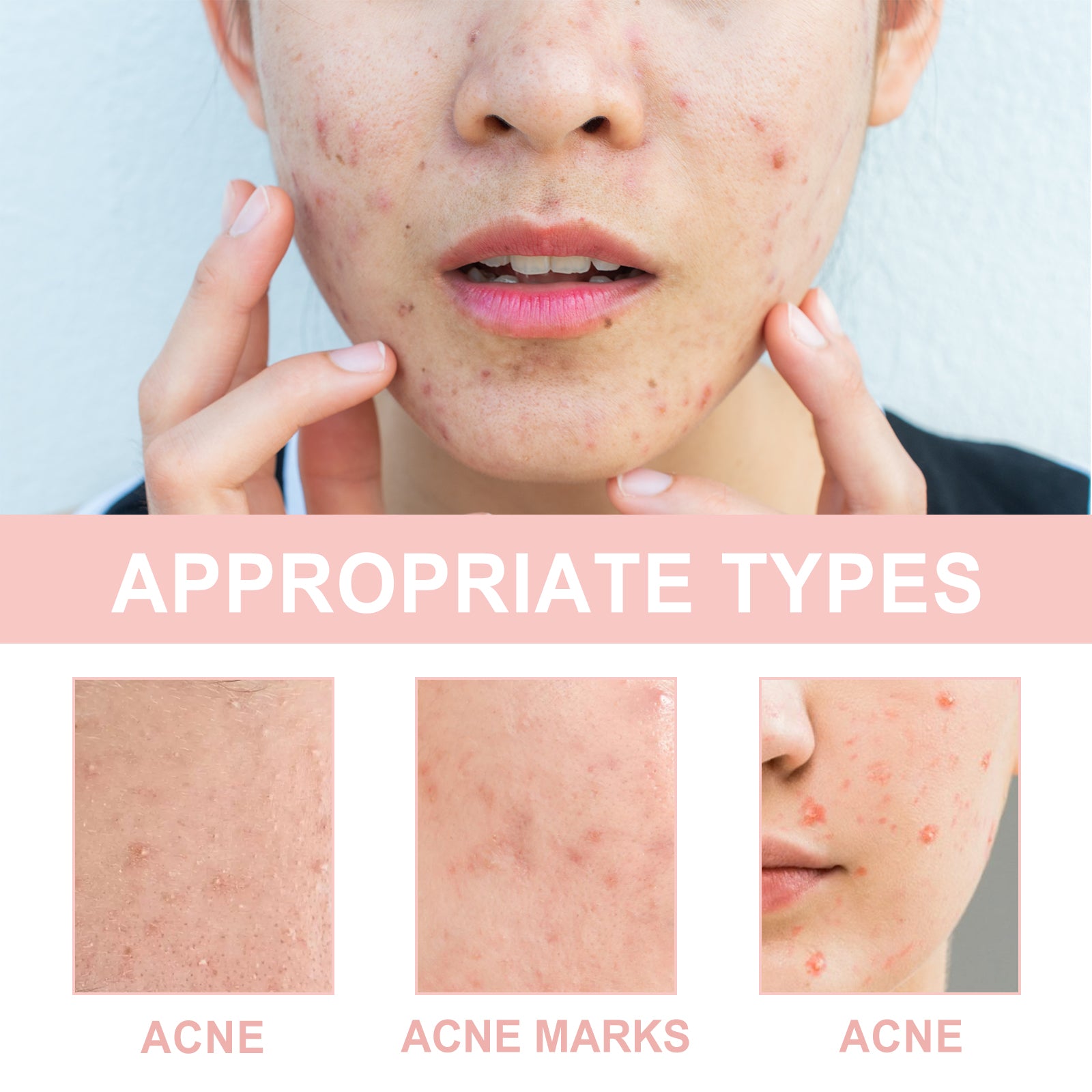 Hydrocolloid Acne Patch
